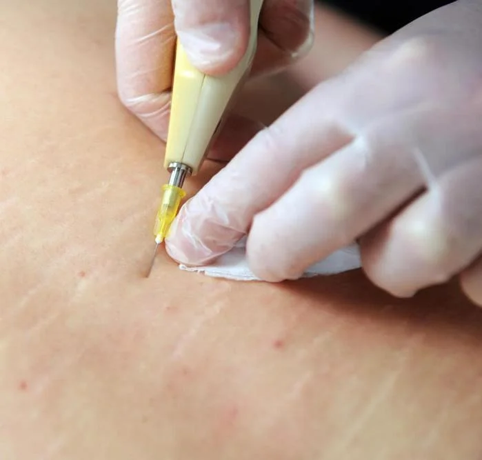 carboxy stretch marks2