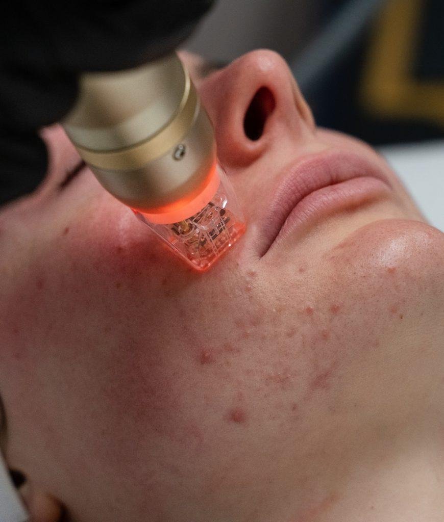 radiofrequency microneedling3