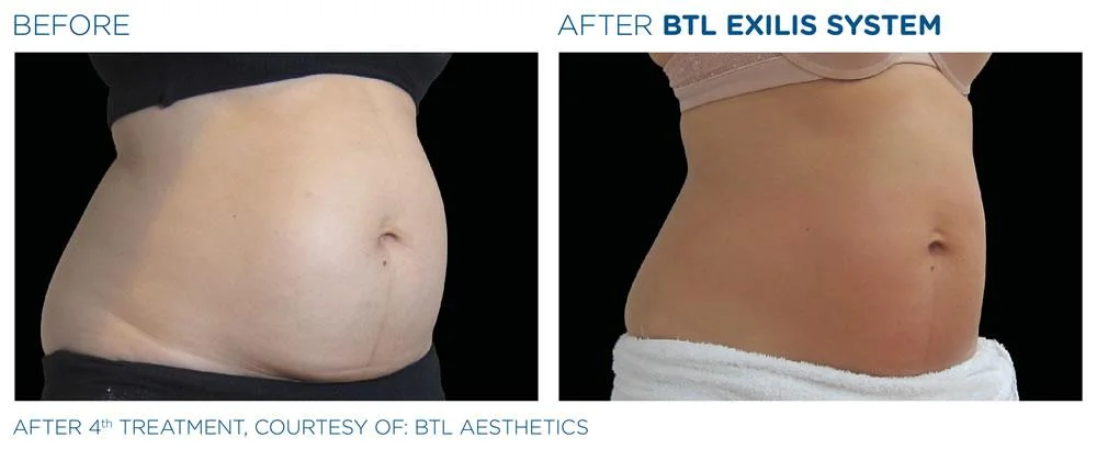 BTL Exilis system PIC Ba card female abdomen 006 EN100 websize