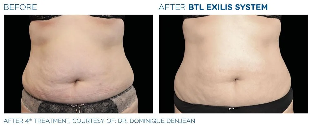 BTL Exilis system PIC Ba card female abdomen 018 EN100 websize
