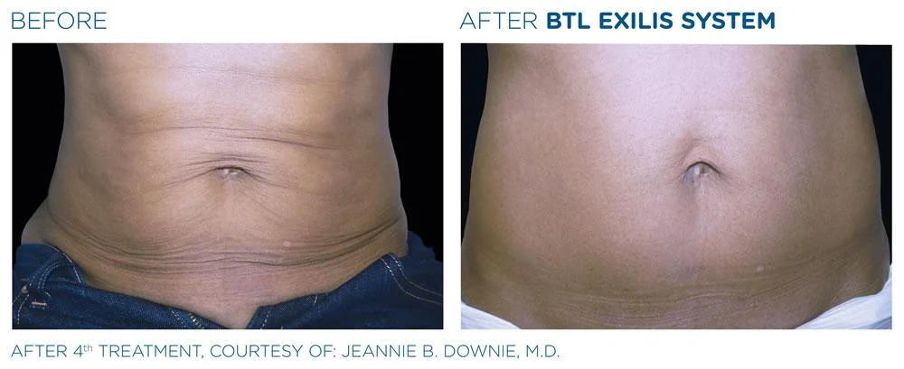 BTL Exilis system PIC Ba card female abdomen 026 EN100 webdesign