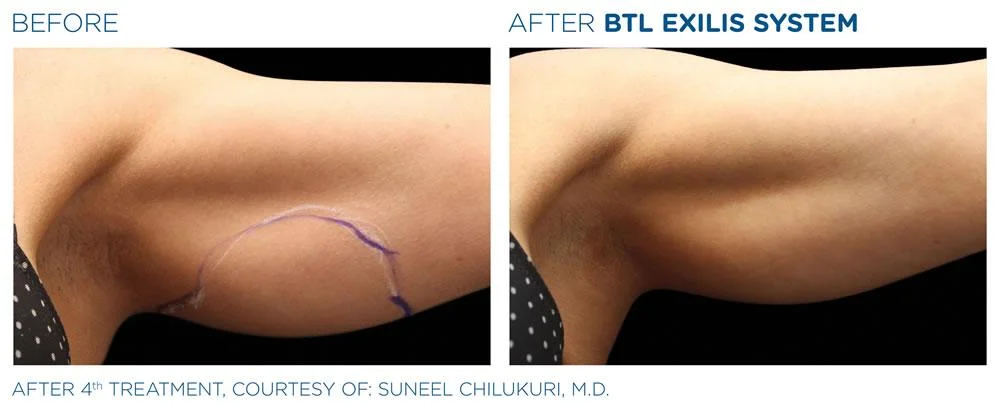 BTL Exilis system PIC Ba card female arms 016 EN100 websize