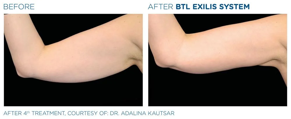 BTL Exilis system PIC Ba card female arms 017 EN100 webdesign