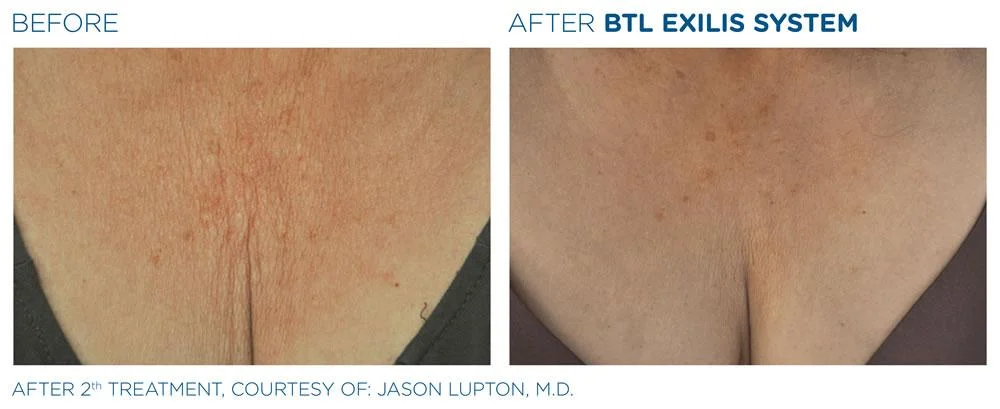 BTL Exilis system PIC Ba card female decollete 014 EN100 webdesign