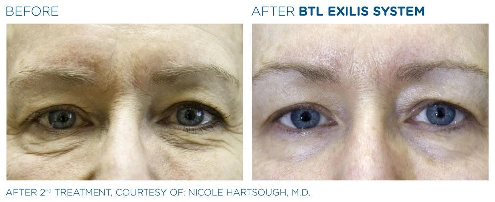 BTL Exilis system PIC Ba card female eyes 024 EN100 websize