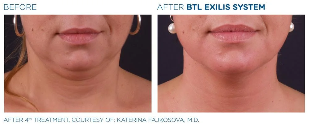 BTL Exilis system PIC Ba card female face 025 EN100 websize