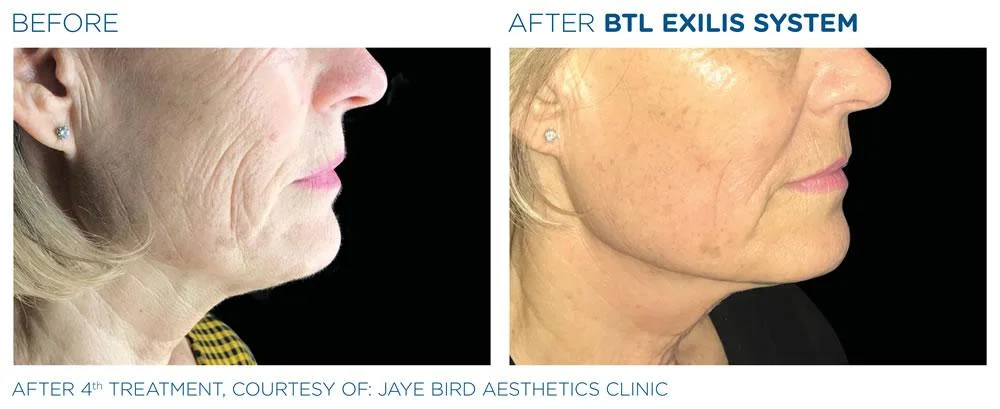 BTL Exilis system PIC Ba card female face neck 012 EN100 websize
