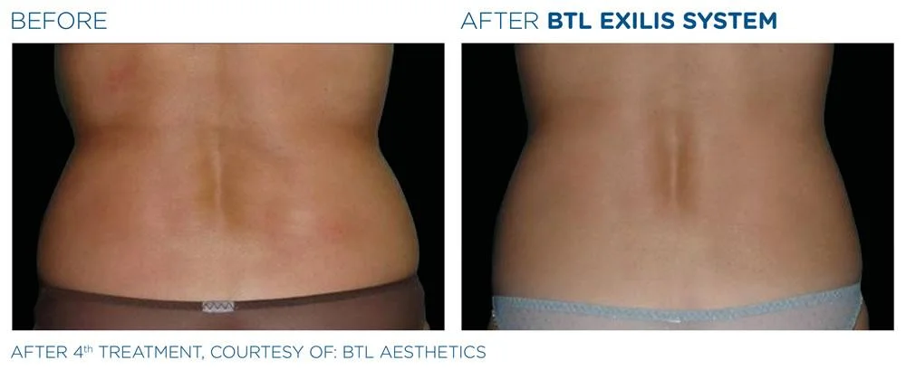 BTL Exilis system PIC Ba card female love handles 008 EN100 websize