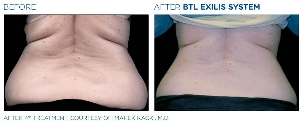 BTL Exilis system PIC Ba card female love handles 019 EN100 webdesign