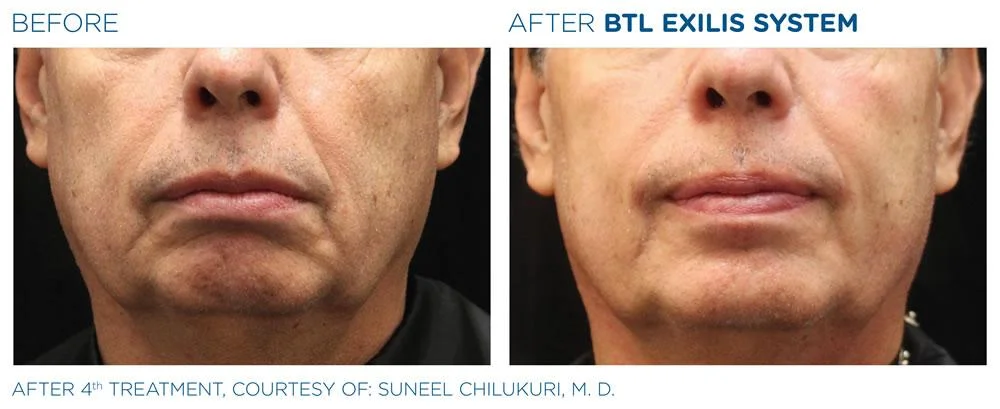 BTL Exilis system PIC Ba card male face 020 EN100 websize