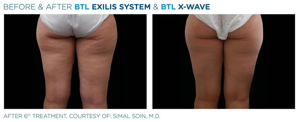 BTL X Wave Exilis System PIC Ba card female buttock 001 EN100 websize