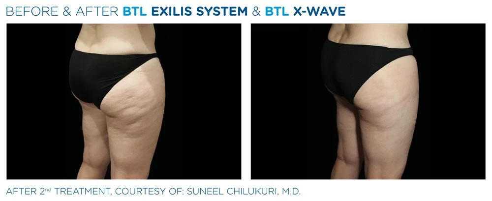 BTL X Wave Exilis System PIC Ba card female buttock 002 EN100 websize