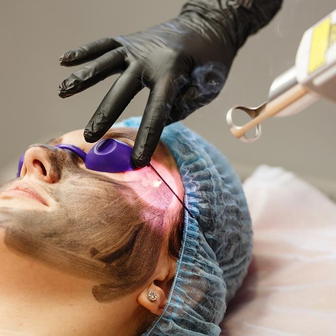 Laser Carboxy Facial Peel