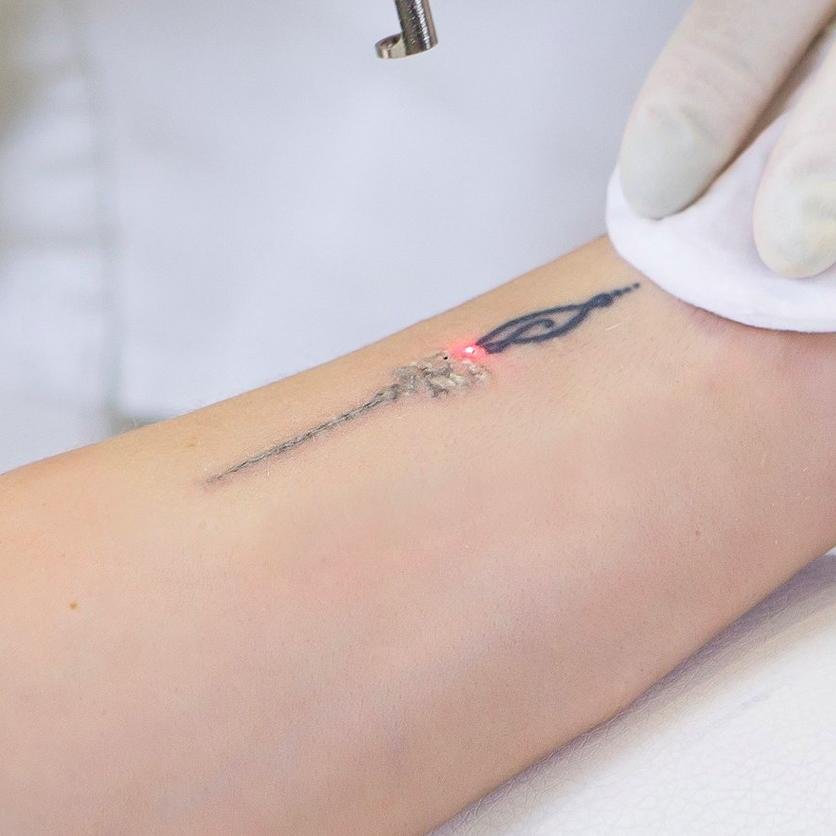 Laser Tattoo Removal